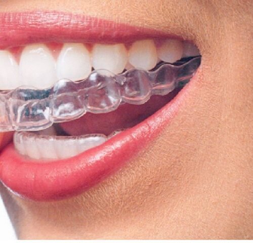 Invisalign-09-1-768x480-1